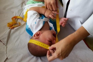 Brasil tem 1.326 casos confirmados de microcefalia